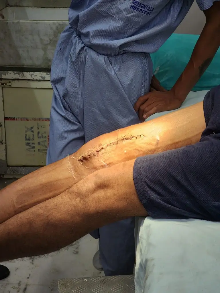 Giant Cell Tumor Best Treatment in Indore – by Dr. Susheel Soni
Clinical Experience
