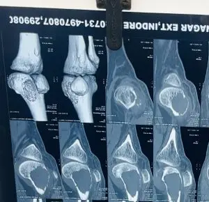 Orthopedic bone tumor surgeon Indore - x ray 